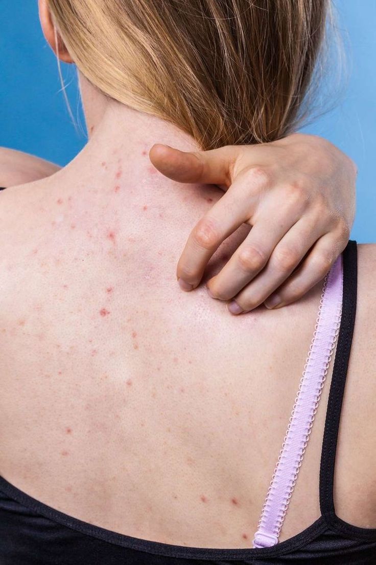 Chica rascándose la espalda con dermatitis